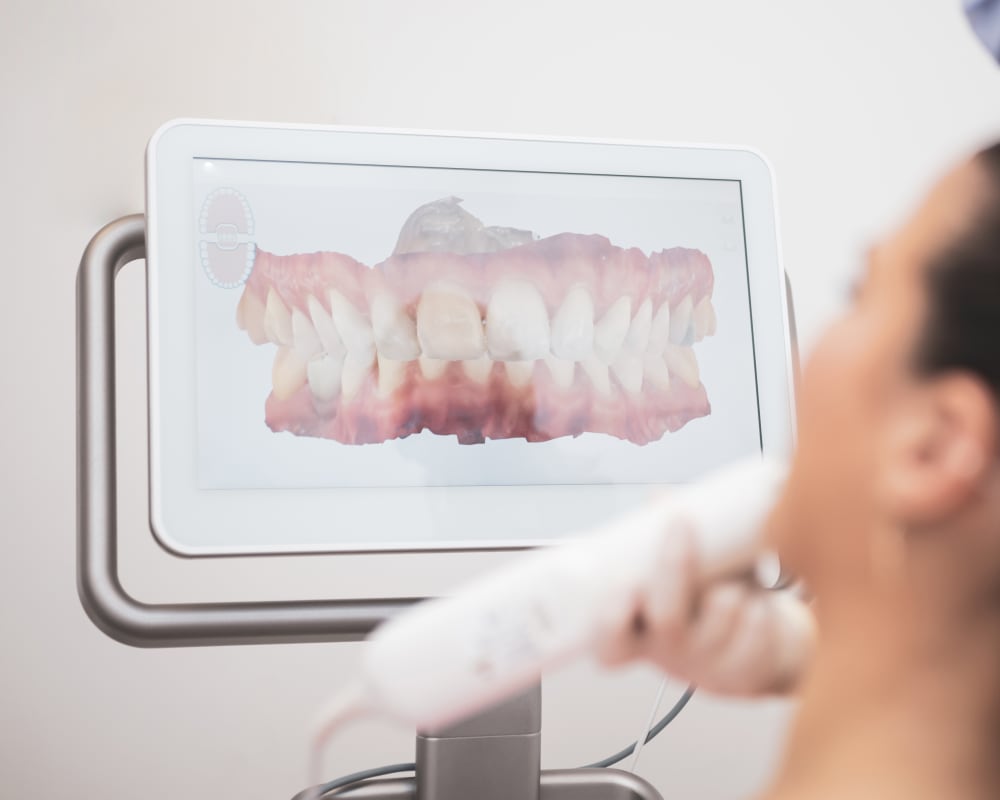 Invisalign Step 2, Dentiste à Longueuil