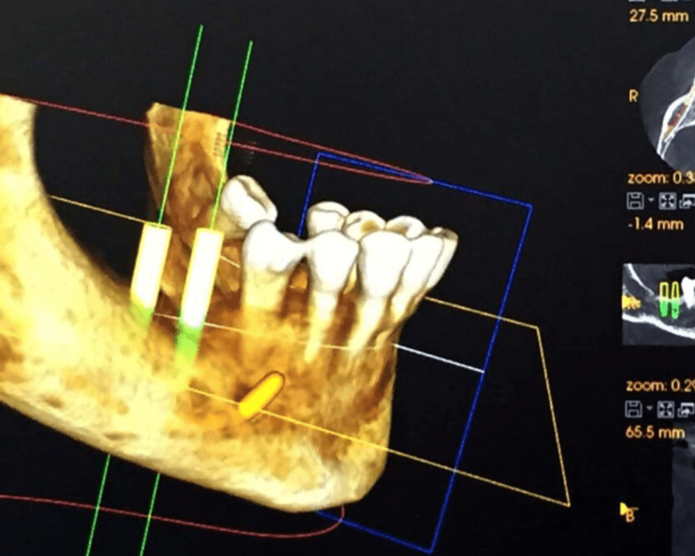 Implants dentaires, Dentiste à Longueuil